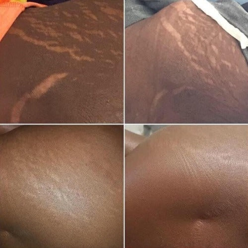 Shea butter for stretch marks before & after